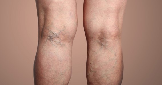 Are There Different Types of Varicose Veins?